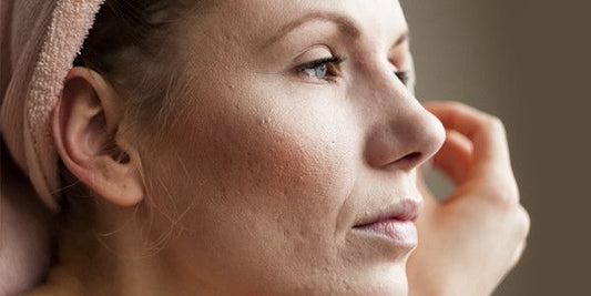 wat is acne en hoe ontstaat het 